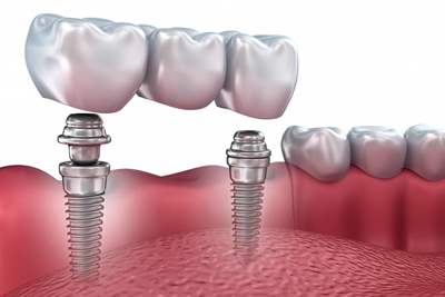 Elevación Seno Maxilar