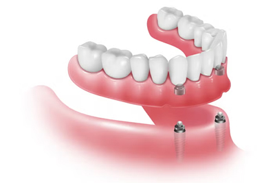 Sobredentadura Inferior